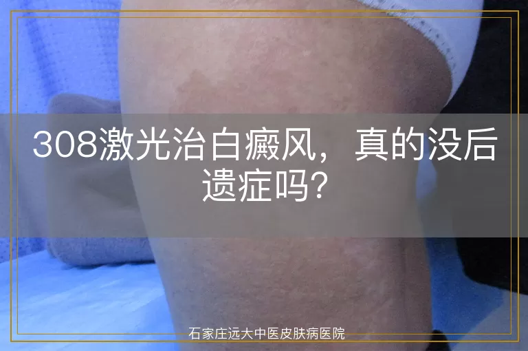 308激光治白癜风，真的没后遗症吗？
