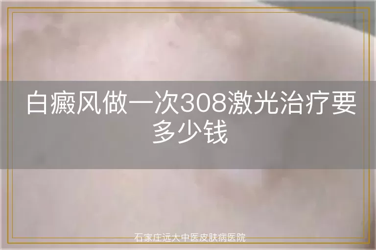 白癜风做一次308激光治疗要多少钱