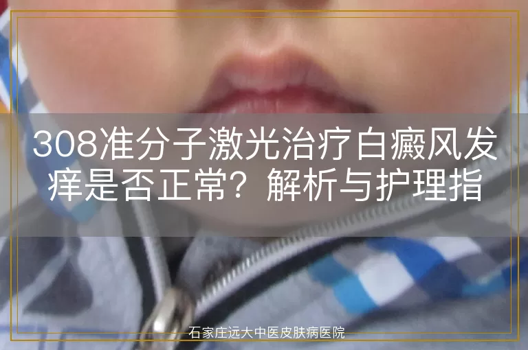 308准分子激光治疗白癜风发痒是否正常？解析与护理指南