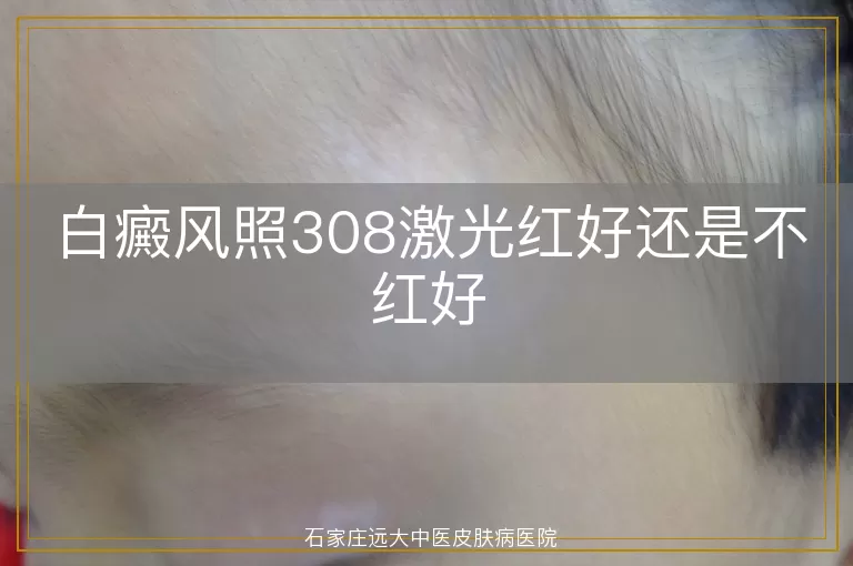 白癜风照308激光红好还是不红好