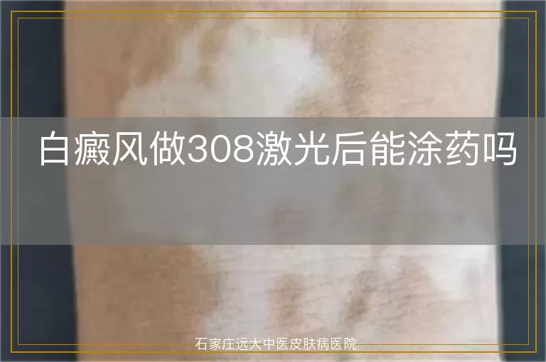白癜风做308激光后能涂药吗