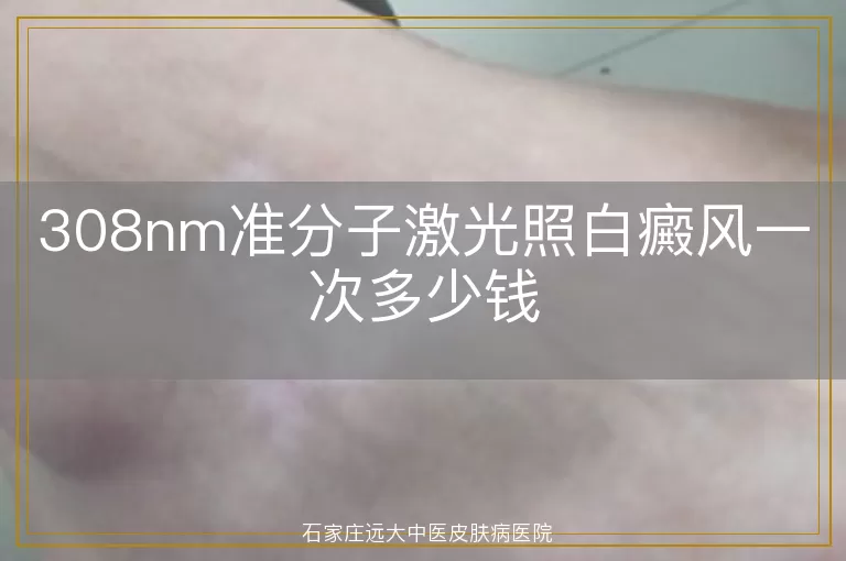 308nm准分子激光照白癜风一次多少钱