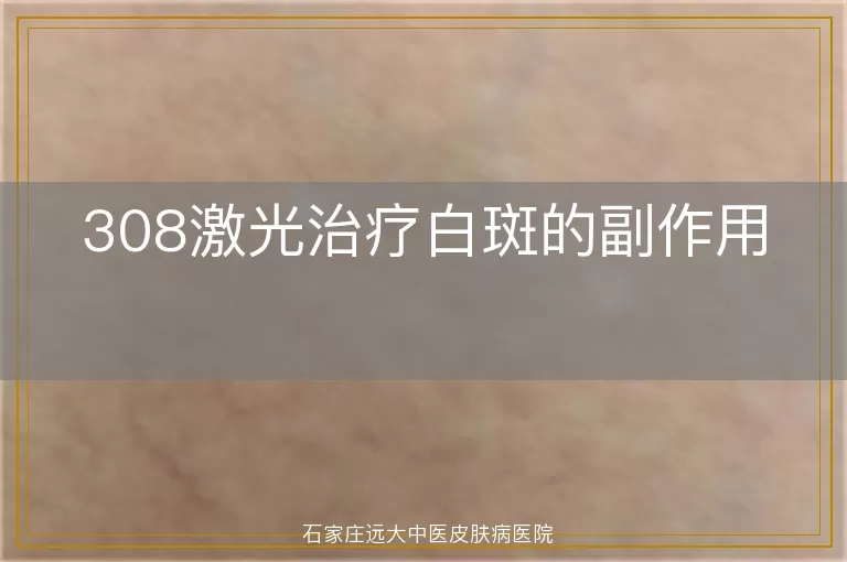 308激光治疗白斑的副作用