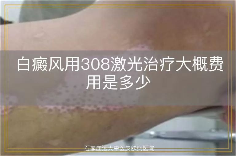 白癜风用308激光治疗大概费用是多少