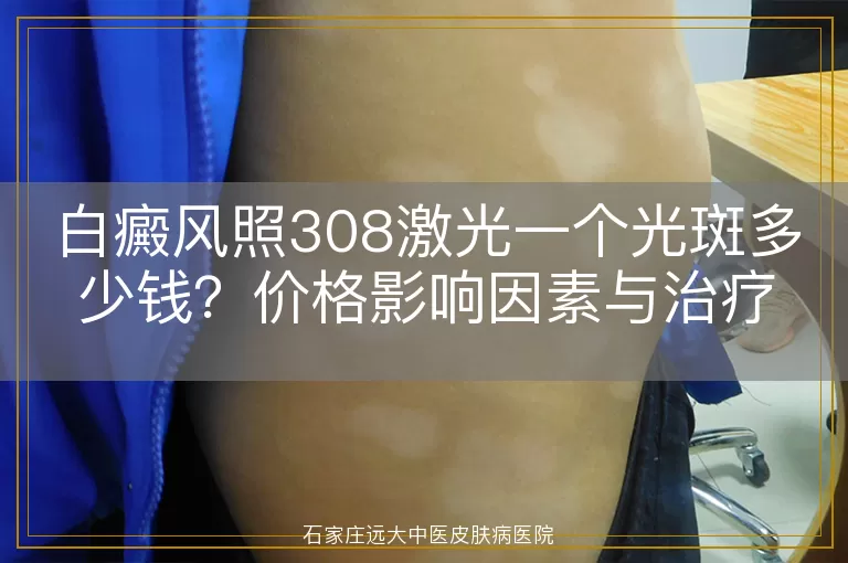 白癜风照308激光一个光斑多少钱?价格影响因素与治疗细节全解析