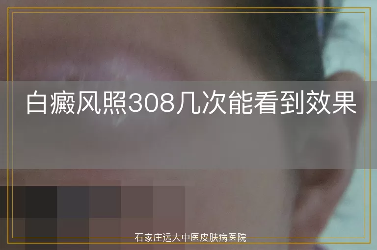 白癜风照308几次能看到效果