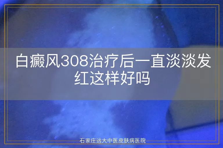 白癜风308治疗后一直淡淡发红这样好吗
