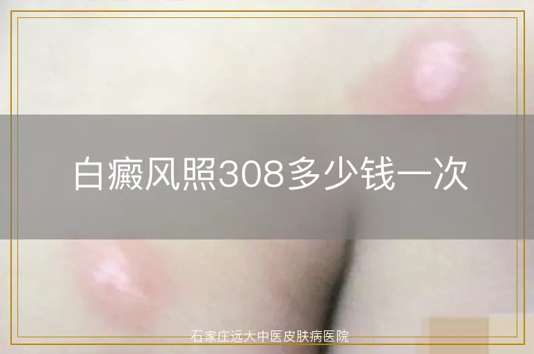 白癜风照308多少钱一次