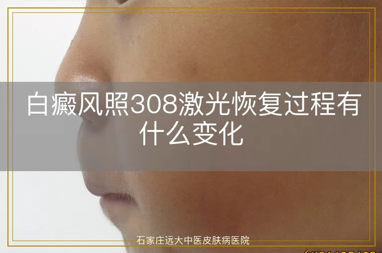 白癜风照308激光恢复过程有什么变化
