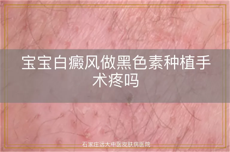 宝宝白癜风做黑色素种植手术疼吗