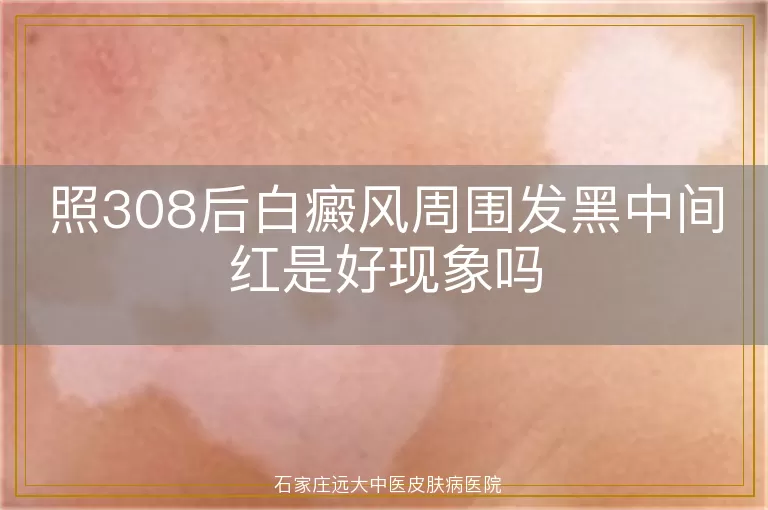 照308后白癜风周围发黑中间红是好现象吗