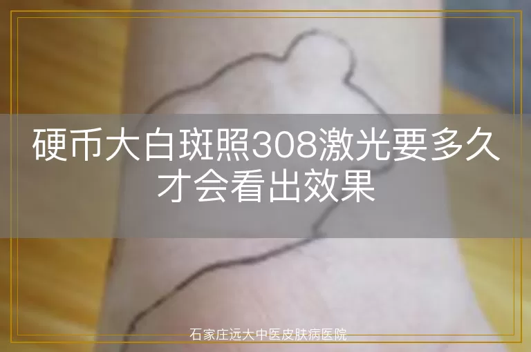 硬币大白斑照308激光要多久才会看出效果