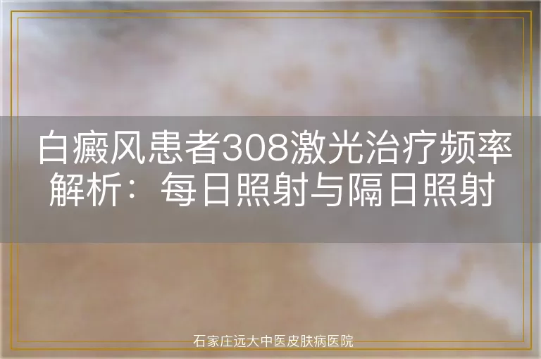 白癜风患者308激光治疗频率解析：每日照射与隔日照射的利弊权衡