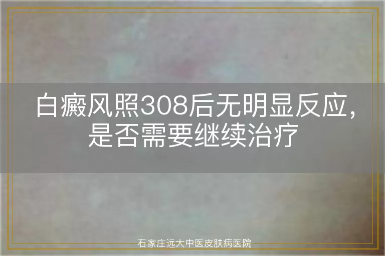 白癜风照308后无明显反应，是否需要继续治疗