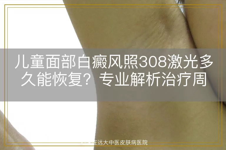 儿童面部白癜风照308激光多久能恢复？专业解析治疗周期与护理要点