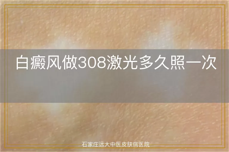 白癜风做308激光多久照一次