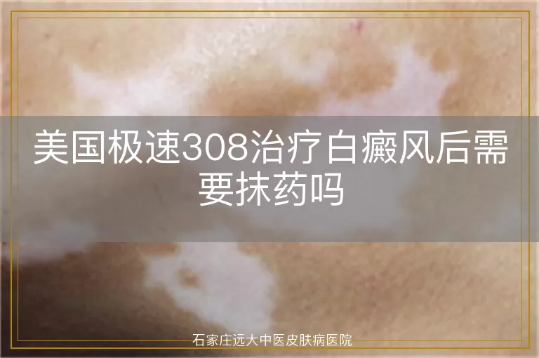 美国极速308治疗白癜风后需要抹药吗