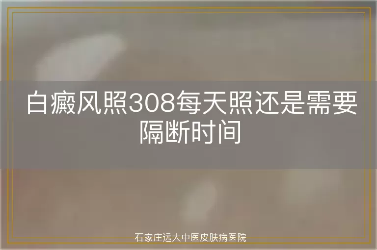 白癜风照308每天照还是需要隔断时间