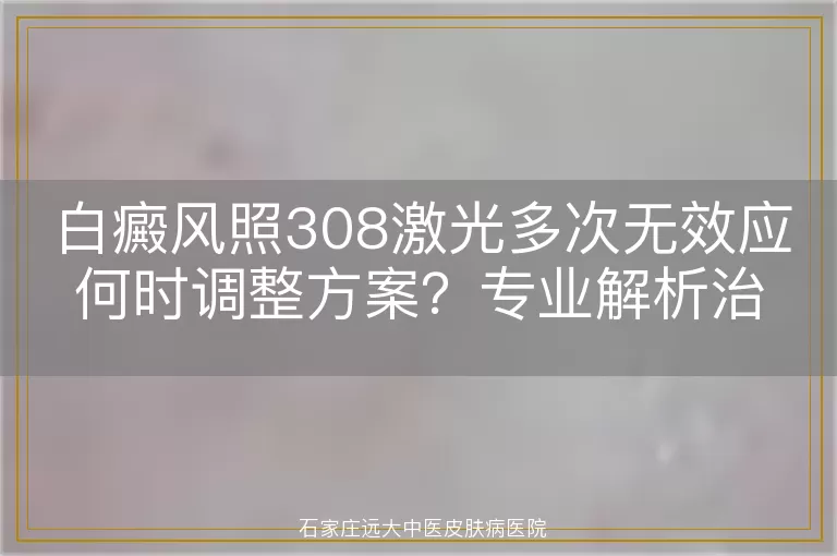 白癜风照308激光多次无效应何时调整方案？专业解析治疗关键节点
