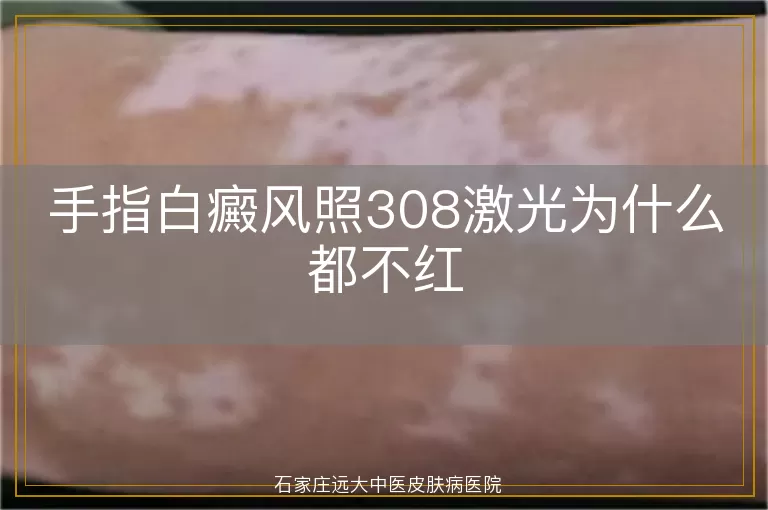 手指白癜风照308激光为什么都不红