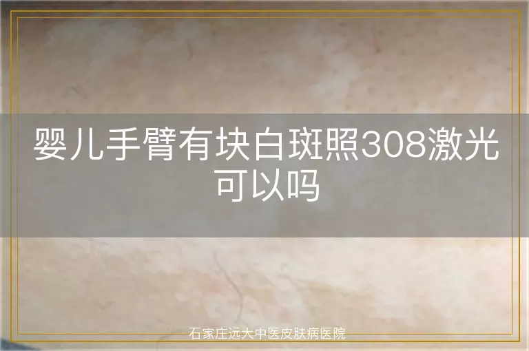 婴儿手臂有块白斑照308激光可以吗