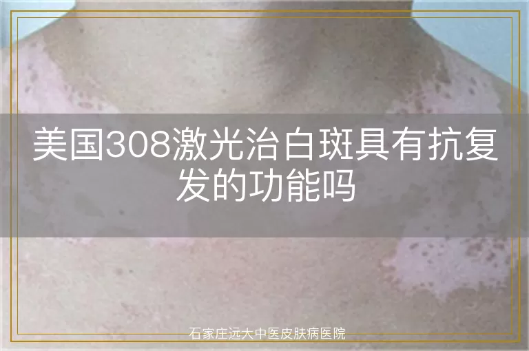 美国308激光治白斑具有抗复发的功能吗