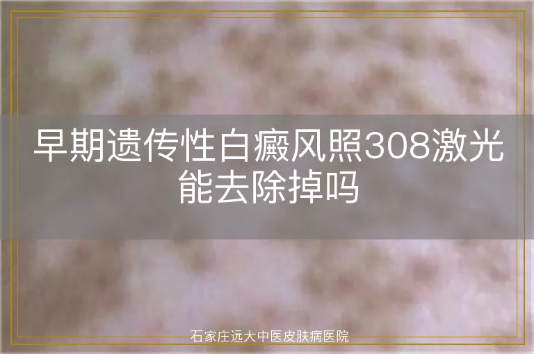 早期遗传性白癜风照308激光能去除掉吗