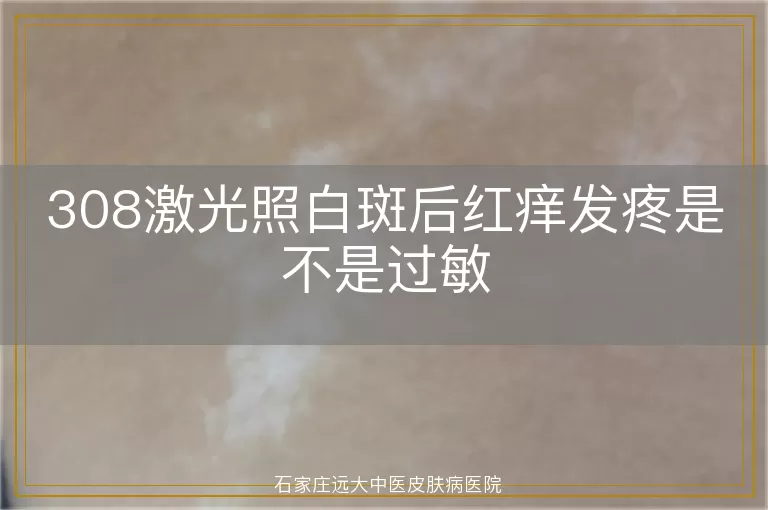 308激光照白斑后红痒发疼是不是过敏