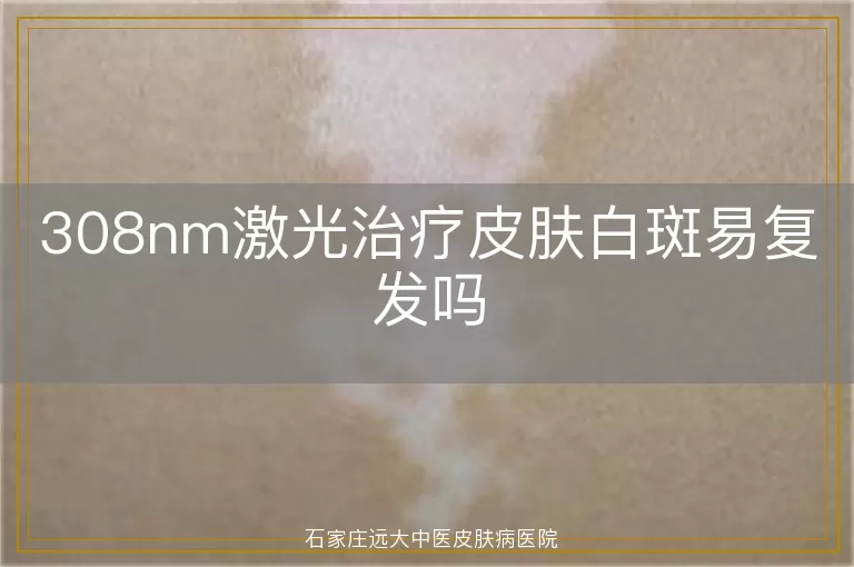 308nm激光治疗皮肤白斑易复发吗