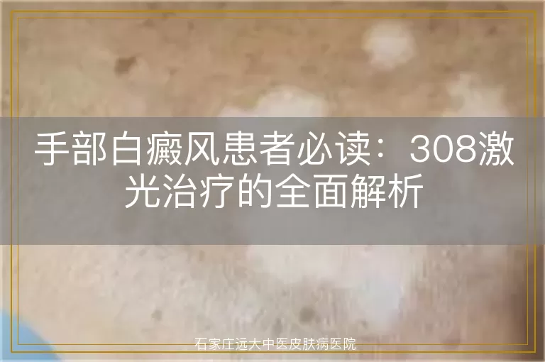 手部白癜风患者必读：308激光治疗的全面解析