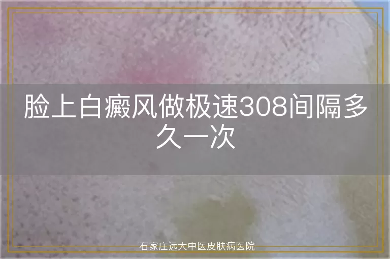 脸上白癜风做极速308间隔多久一次
