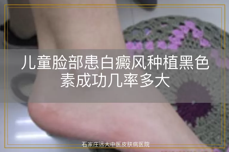 儿童脸部患白癜风种植黑色素成功几率多大