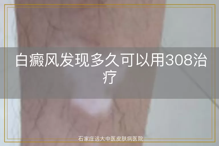 白癜风发现多久可以用308治疗