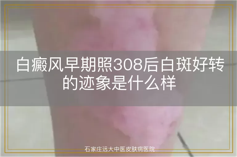 白癜风早期照308后白斑好转的迹象是什么样