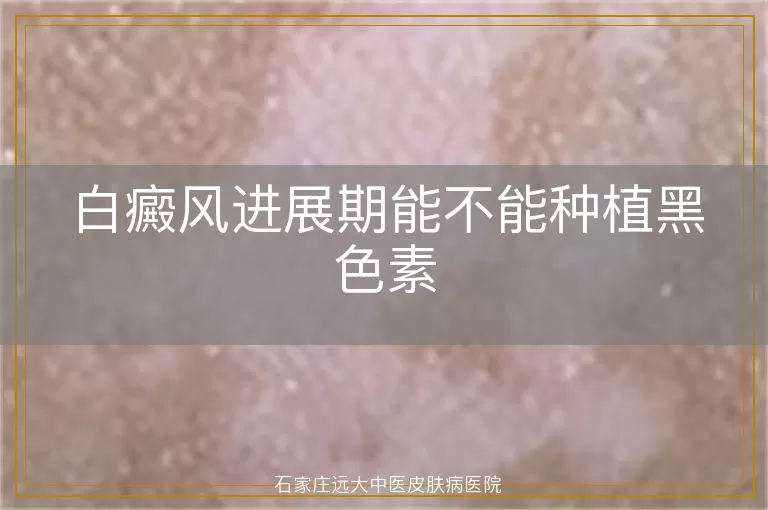白癜风进展期能不能种植黑色素