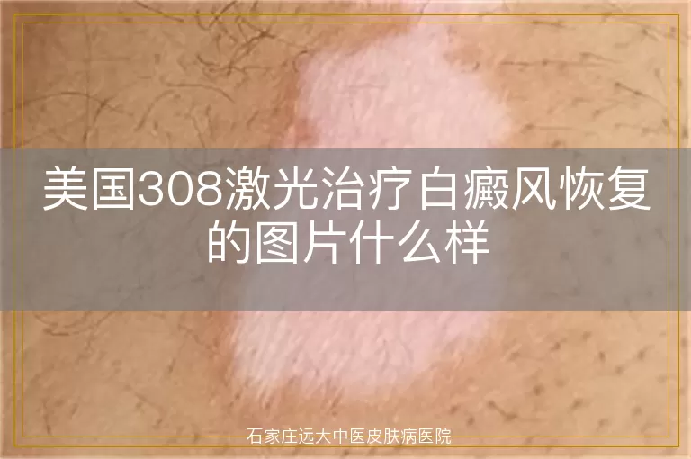 美国308激光治疗白癜风恢复的图片什么样
