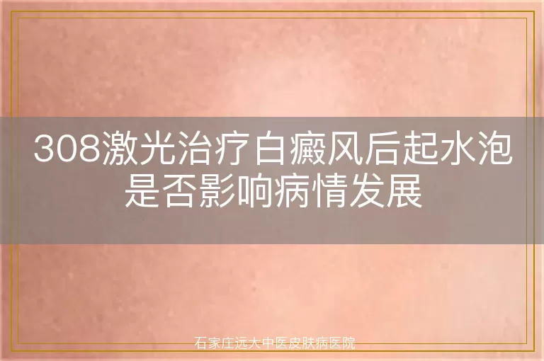 308激光治疗白癜风后起水泡是否影响病情发展
