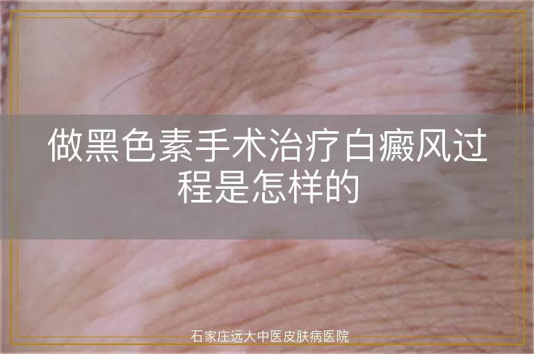 做黑色素手术治疗白癜风过程是怎样的