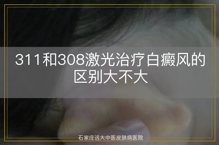 311和308激光治疗白癜风的区别大不大