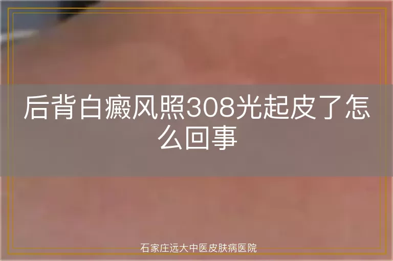 后背白癜风照308光起皮了怎么回事