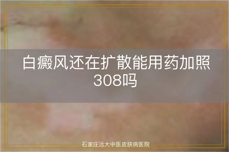 白癜风还在扩散能用药加照308吗