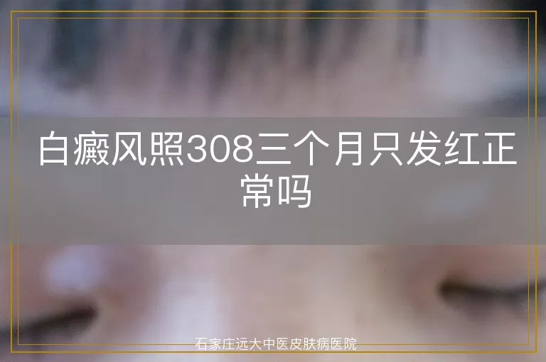 白癜风照308三个月只发红正常吗