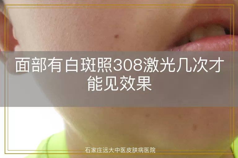 面部有白斑照308激光几次才能见效果