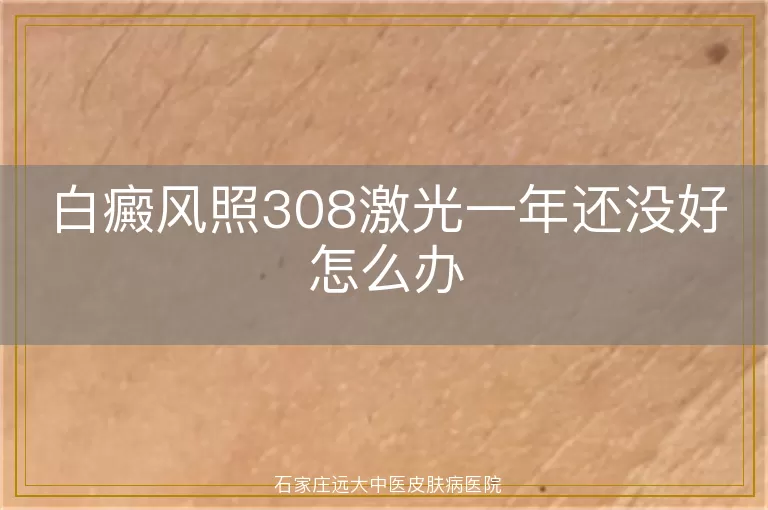 白癜风照308激光一年还没好怎么办
