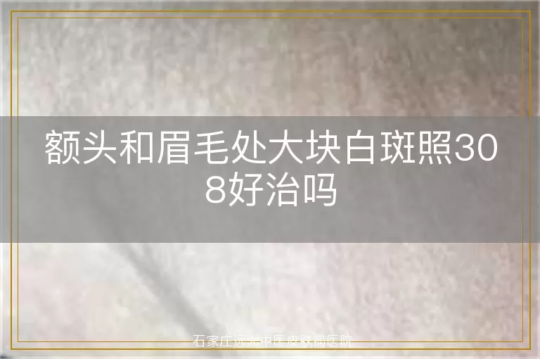 额头和眉毛处大块白斑照308好治吗