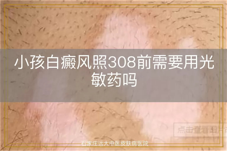 小孩白癜风照308前需要用光敏药吗