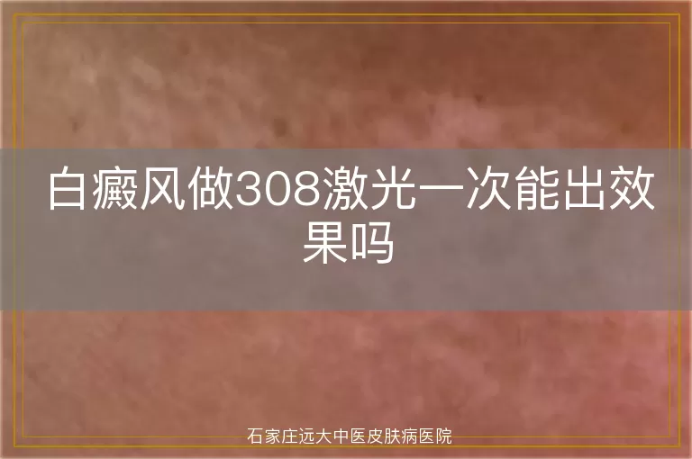 白癜风做308激光一次能出效果吗