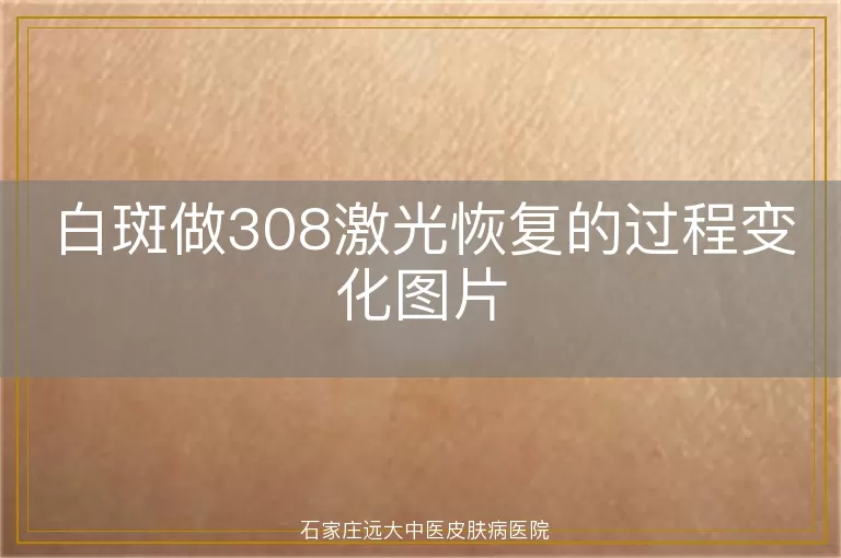 白斑做308激光恢复的过程变化图片