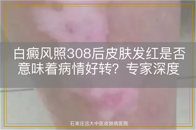 白癜风照308后皮肤发红是否意味着病情好转？专家深度解析
