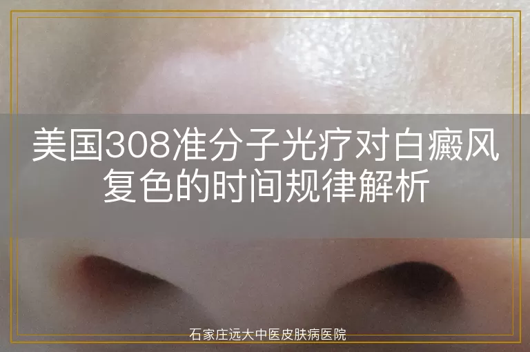 美国308准分子光疗对白癜风复色的时间规律解析